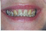 Dental Bridges and Crowns - Southern Indiana