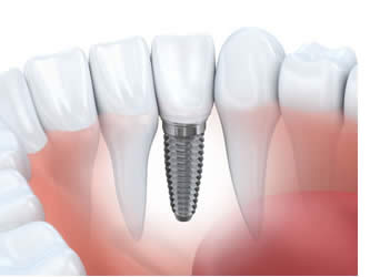 Dental Crowns and Bridges - Blincoe and Shutt Aesthetic Dentistry