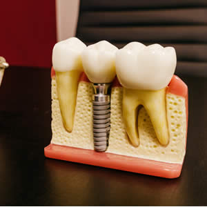 Dental Implants - Blincoe and Shutt Aesthetic Dentistry